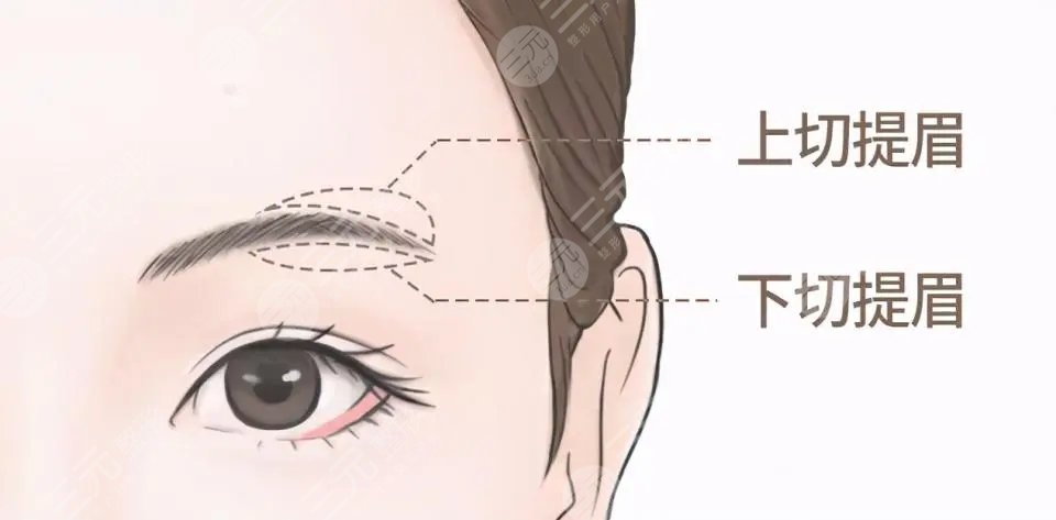 韩式提眉多少钱? 韩式提眉多少钱?