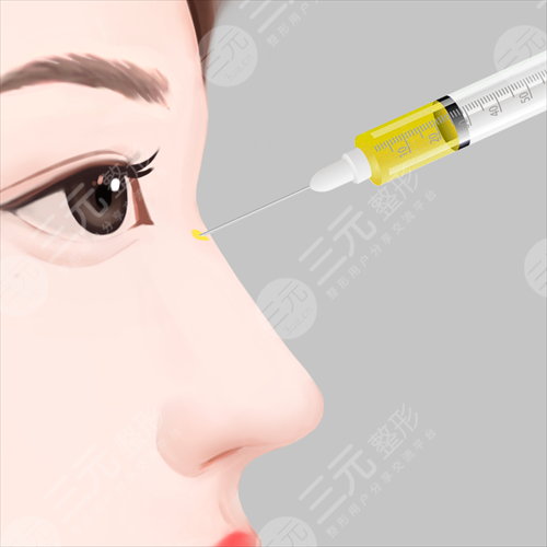 人工骨隆鼻能用多少年?美鼻使用年限了解一下 人工骨隆鼻能用多少年?美鼻使用年限了解一下