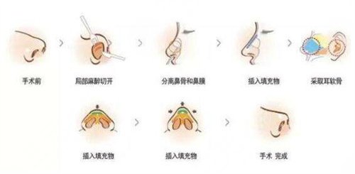 隆鼻手术图片过程图片公开分享,想美不用怕,看完这篇你就懂了! 隆鼻手术图片过程图片公开分享,想美不用怕,看完这篇你就懂了!