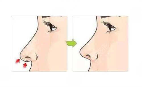 鼻小柱延长前后对比：体会到了美鼻的重要性！