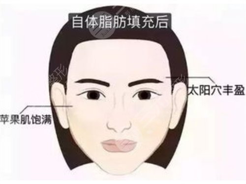 鼻唇沟去除手术怎么做?果好不好?科普来咯~ 鼻唇沟去除手术怎么做?果好不好?科普来咯~