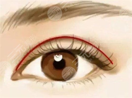 上眼皮松弛矫正术恢复期有多久？睛彩美眼要耐心！
