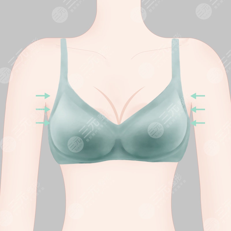 胸部整形注射隆胸失败如何进行修复?