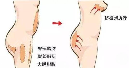 胸部整形手术项目有哪些?如何正确利用手术合理的隆胸? 胸部整形手术项目有哪些?如何正确利用手术合理的隆胸?