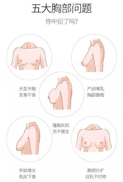 广州做假体隆胸手术多少钱