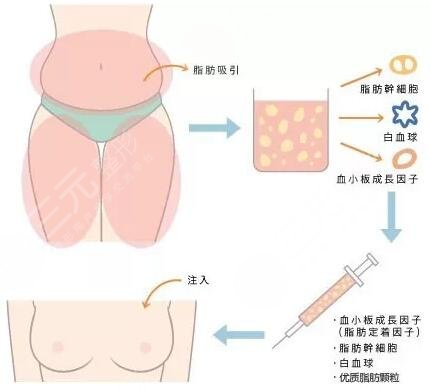 自体脂肪隆胸与假体隆胸的优缺点对比