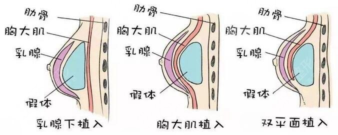 隆胸究竟好不好?有什么并发症和风险我们要知道?