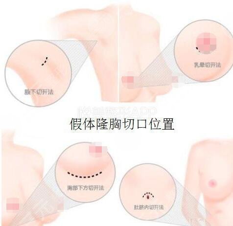 假体隆胸有什么好和不好的?具体有什么优缺点呢?