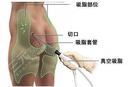 <b>抽脂塑身 这个春天你S了吗?</b>