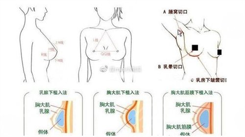 <b>假体隆胸的手术须知</b>