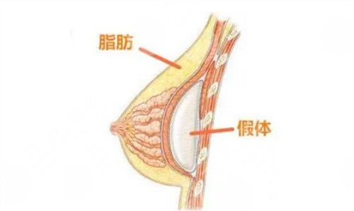 副乳切除的相关知识