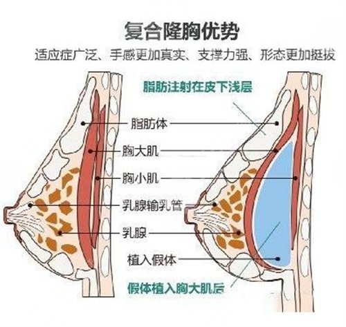 麦格假体隆胸有哪些可靠性