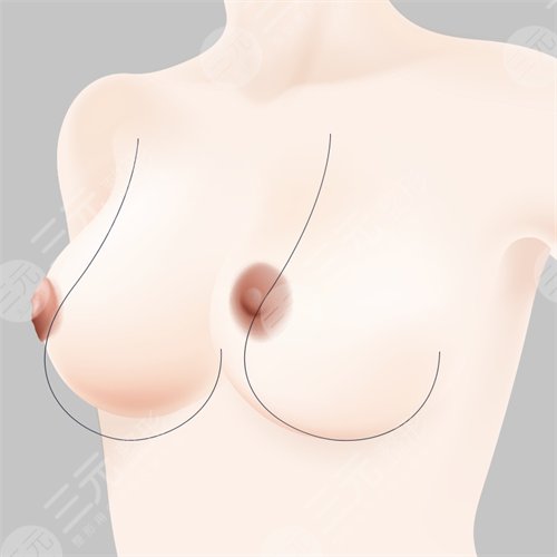 <b>乳房下垂矫正的手术方法</b>