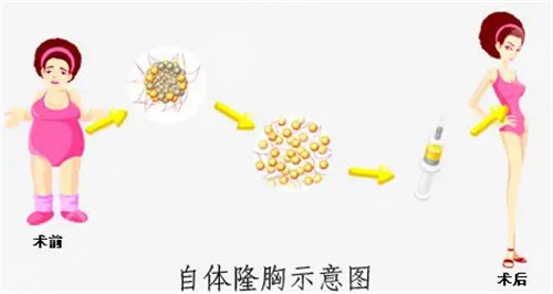 自体脂肪丰胸怎么样 自体脂肪丰胸的成好吗