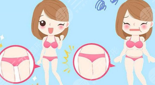 吸脂减肥会不会有后遗症