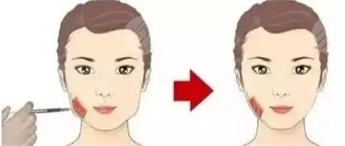 做去双下巴手术有风险和后遗症吗？