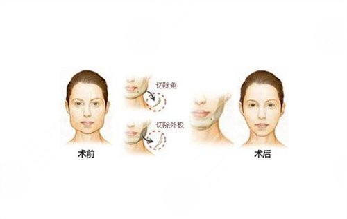磨腮削骨有后遗症吗 磨腮削骨前后对比图