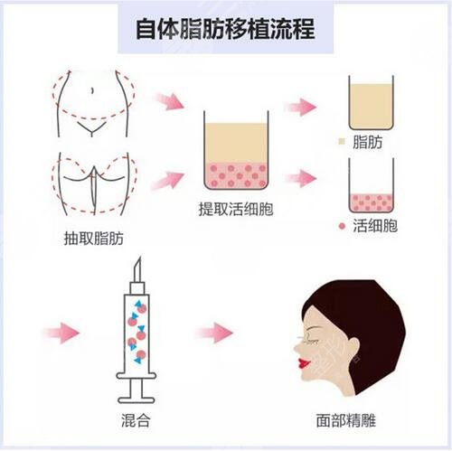 自体脂肪填充是长时间的吗？北京自体脂肪填充好的医院