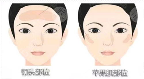 面部填充果怎么样?试试不就知道了