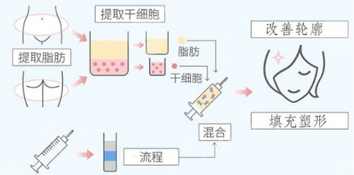 自体脂肪丰额头降低风险吗