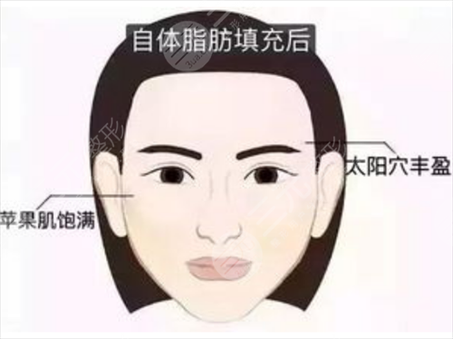 成都自体脂肪面部填充要多少钱