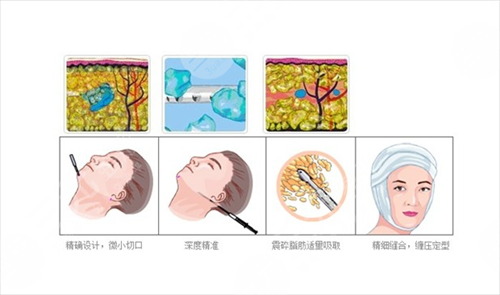 面部吸脂好吗 面部吸脂果怎么样