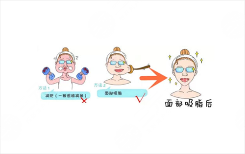 面部吸脂瘦脸有什么优点