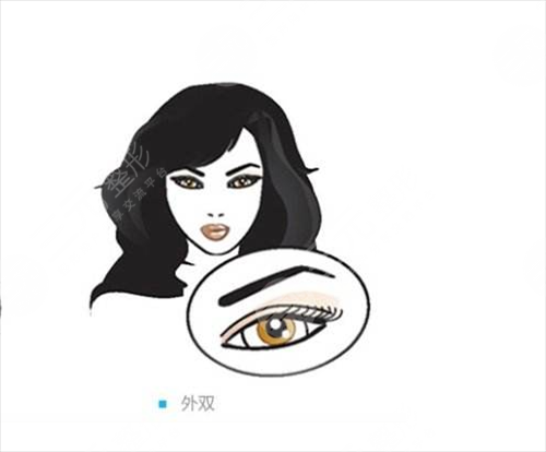 肉泡眼怎么办 肉泡眼去除术来帮您 肉泡眼怎么办 肉泡眼去除术来帮您