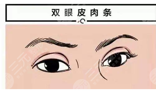 上睑下垂矫正术缓解方法 上睑下垂矫正术缓解方法