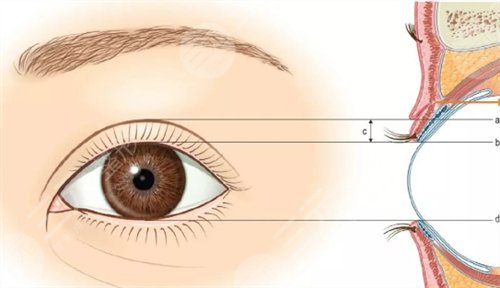 纹眼线几天能恢复，纹眼线后如何护理