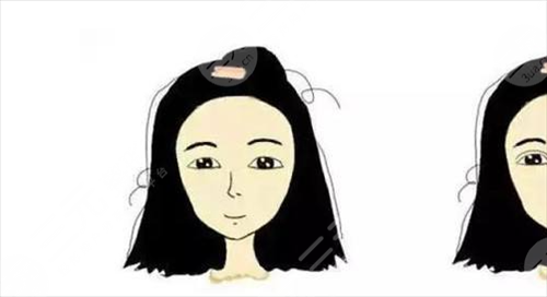 单眼皮下垂矫正手术怎么样