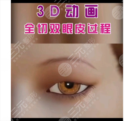 四个眼睑整形手术方法异同对比