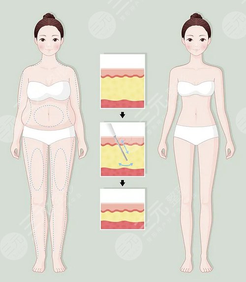 打完注射瘦腿后多久可以运动