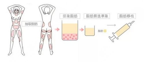 打注射瘦腿会影响走路吗