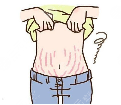 产后如何去掉腹部肚皮妊娠纹 去除产后腹部肚皮妊娠纹的喜欢办法