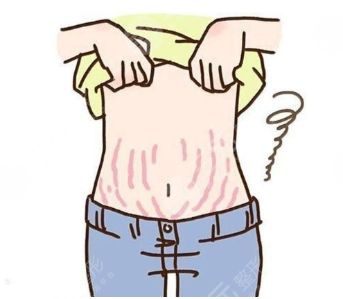 激光祛妊娠纹果怎么样 激光去妊娠纹的优势 激光祛妊娠纹果怎么样 激光去妊娠纹的优势
