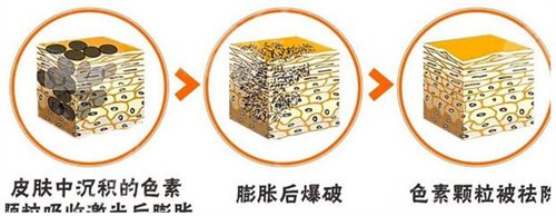 长老年斑是什么原因、怎样去除手上的老年斑 长老年斑是什么原因、怎样去除手上的老年斑
