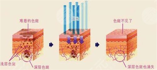 激光点痣一个多少钱 成都医院激光祛痣价格