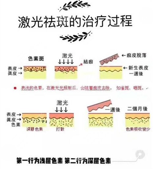 如何有的缓解咖啡斑？激光祛除的果怎么样？会复发吗？