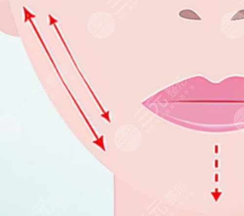 肥胖纹可以消除吗?怎么去肥胖纹？