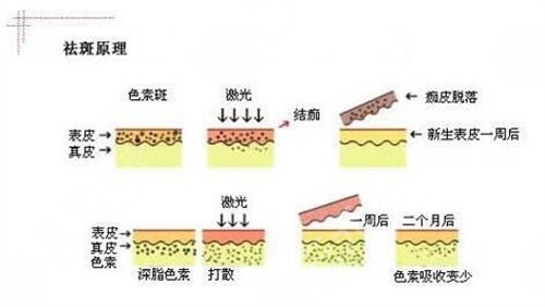西昌c6激光祛斑价格介绍